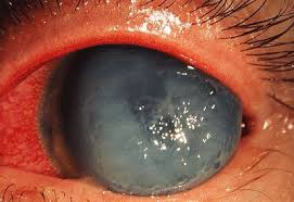 Cornea & External Disease Services Image